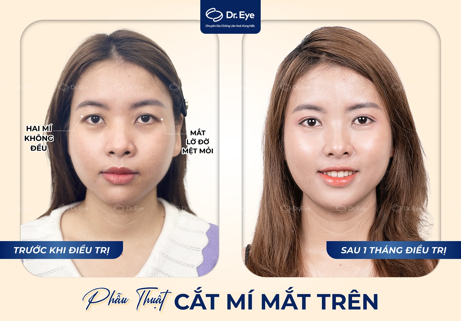 Kết quả cắt mí mắt tại Dr. Eye – Chị Thanh Huyền, mắt to tròn tự nhiên